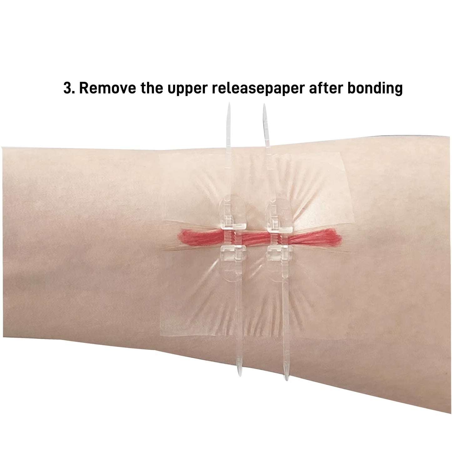 Self-Adhesive Zipper Wound Closure Tape Kit